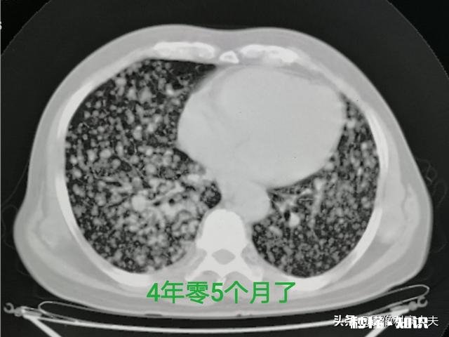 为什么说癌症是慢性病