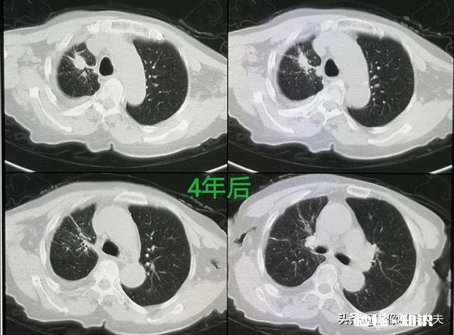 为什么说癌症是慢性病