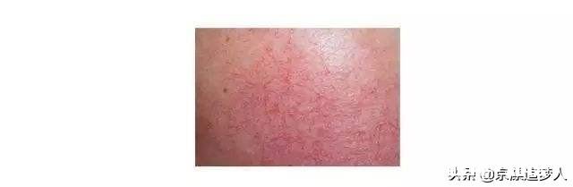 脸上为什么会出现红血丝呢