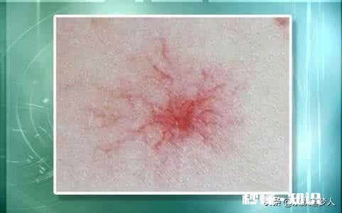 脸上为什么会出现红血丝呢