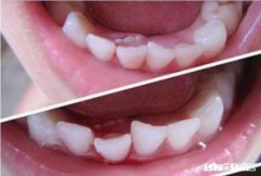 我家大宝六岁了，乳牙没掉里边又长出一颗大牙怎么回事