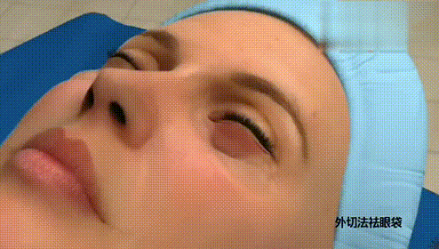 眼袋大是什么原因造成的