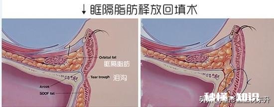 眼袋大是什么原因造成的