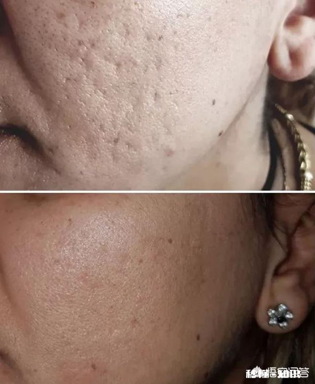 脸上有痘坑，用什么化妆品比较好有推荐的吗