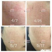 如何辨别顾客是过敏肌还是敏感肌