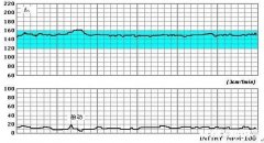 怀孕36周，胎心监护不好怎么办
