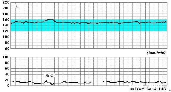 怀孕36周，胎心监护不好怎么办