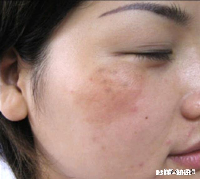 什么叫黄褐斑，雀斑，有什么分别吗