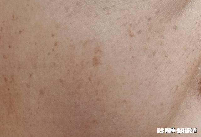 什么叫黄褐斑，雀斑，有什么分别吗