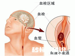 脑血栓后遗症患者身体到处疼痛吗