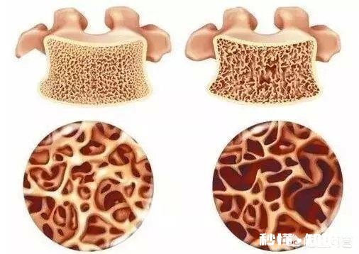 骨刺是病吗怎么办