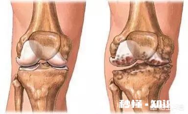 骨刺是病吗怎么办