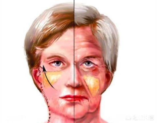 害怕法令纹会暴露年龄，怎么改善令人讨厌的法令纹