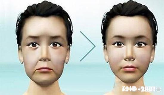 害怕法令纹会暴露年龄，怎么改善令人讨厌的法令纹