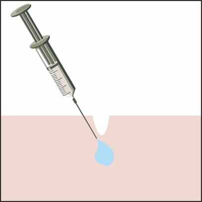 害怕法令纹会暴露年龄，怎么改善令人讨厌的法令纹