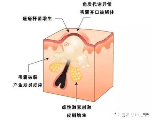 油皮痘肌怎样改善