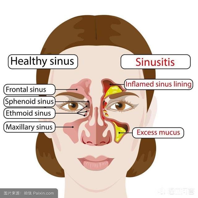 儿童鼻窦炎需要吃抗生素吗