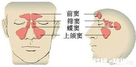 儿童鼻窦炎需要吃抗生素吗