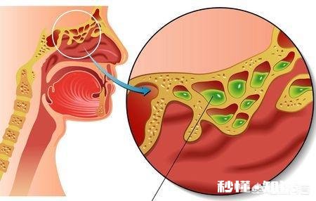 儿童鼻窦炎需要吃抗生素吗