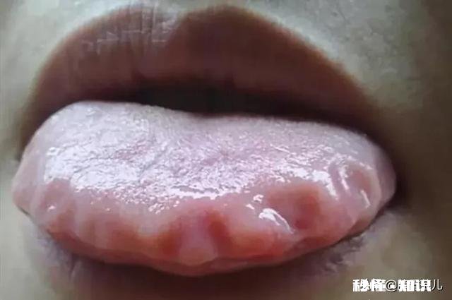 脾虚有什么症状长期脾虚会有什么危害