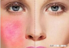 红血丝如何祛除