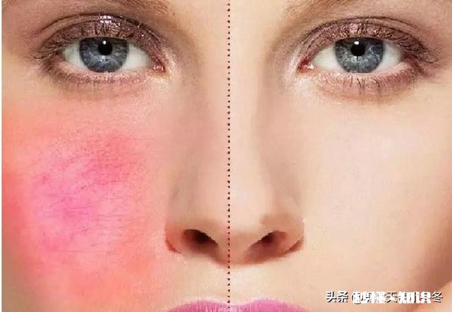 红血丝如何祛除