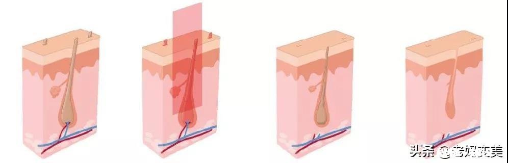 脸上长毛，要每天都刮，请问怎么脱毛最有效，求帮忙