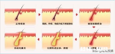 脸上长毛，要每天都刮，请问怎么脱毛最有效，求帮忙