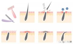 脸上长毛，要每天都刮，请问怎么脱毛最有效，求帮忙