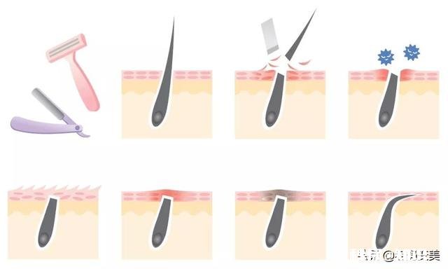 脸上长毛，要每天都刮，请问怎么脱毛最有效，求帮忙