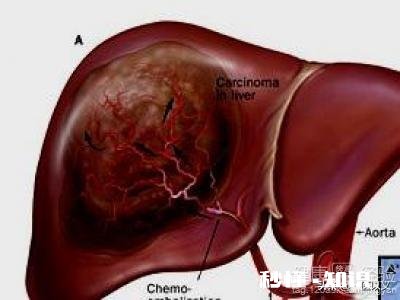 肝癌术后患者很容易复发吗
