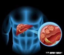 肝癌术后患者很容易复发吗