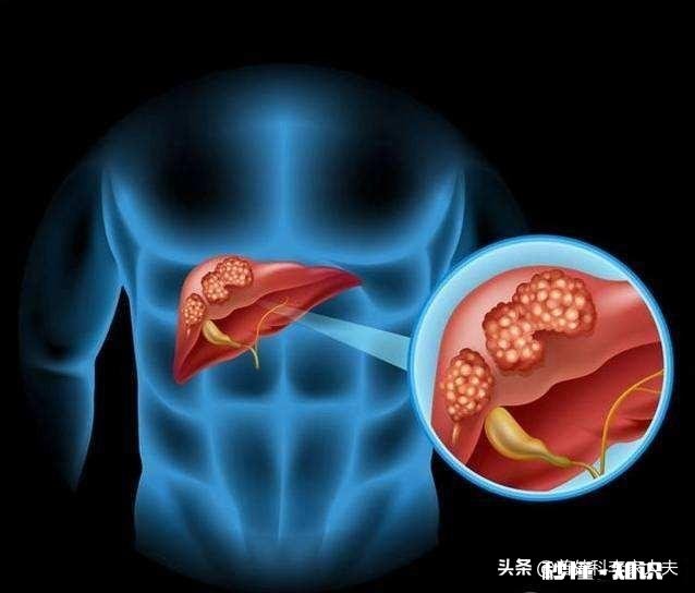 肝癌术后患者很容易复发吗