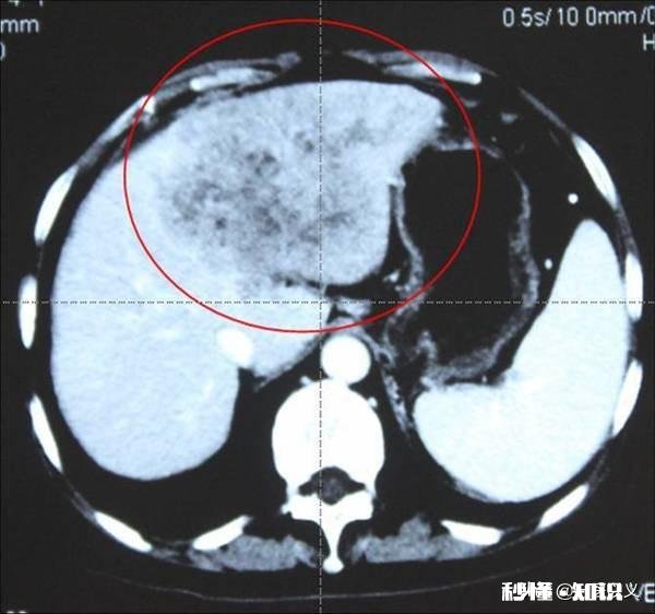 肝癌术后患者很容易复发吗
