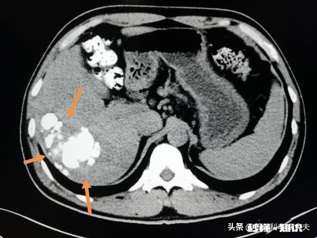 肝癌术后患者很容易复发吗