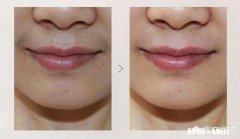 女人的小胡子该怎么去掉