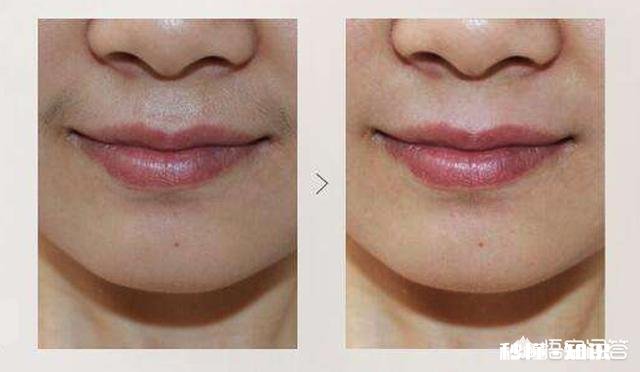 女人的小胡子该怎么去掉