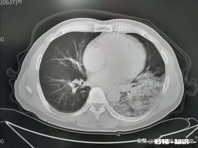 细菌性肺炎和病毒性肺炎怎么判断