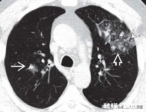 细菌性肺炎和病毒性肺炎怎么判断