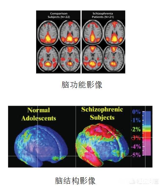 精神分裂症每犯一次都会伤害一次大脑吗