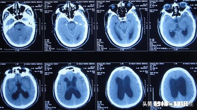 精神分裂症每犯一次都会伤害一次大脑吗
