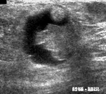 哺乳期，胸部有硬块而且疼痛，宝宝吸不出来不愿意吃了，催乳师都揉不开，还有什么办法