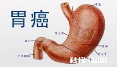 80%的胃癌发现时已是晚期，如何才能早发现