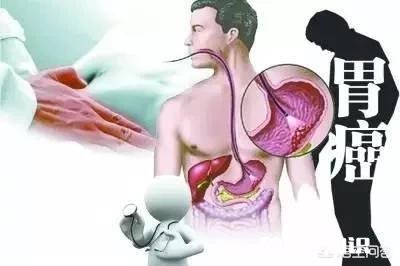 80%的胃癌发现时已是晚期，如何才能早发现