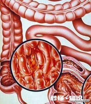 溃疡性结肠炎能活多久