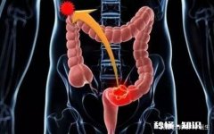 27岁得肠癌几率大吗