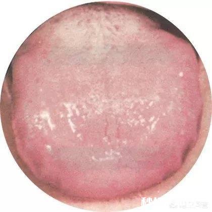 湿气重导致老是长痘痘,该怎么办