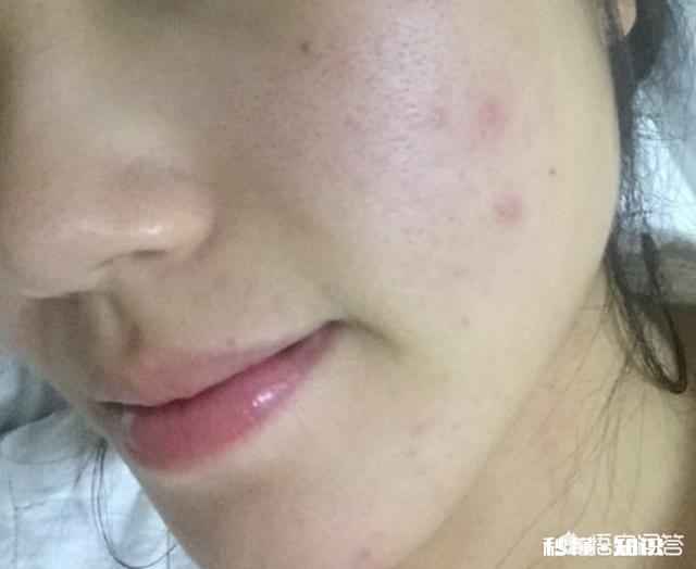 湿气重导致老是长痘痘,该怎么办