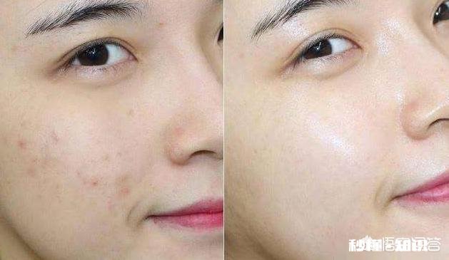 湿气重导致老是长痘痘,该怎么办