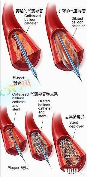 心梗以后，还要不要去好点的医院去做支架